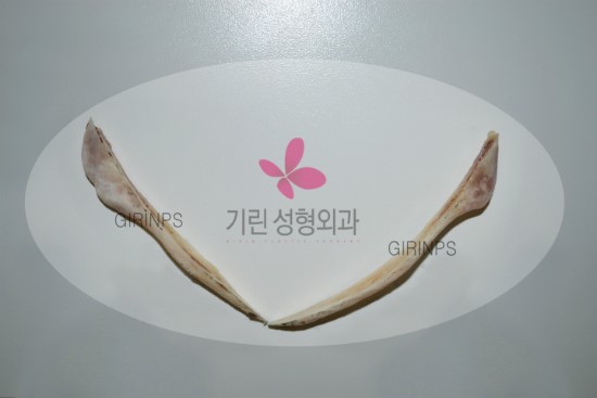 티절골로 제거된 실제 뼈모양과 위치 관련 이미지 4
