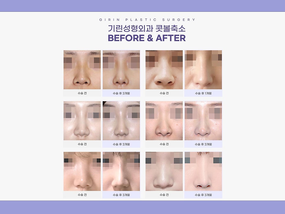 비절개콧볼축소수술 자연스럽고 예쁜 코 만들기 관련 이미지 7