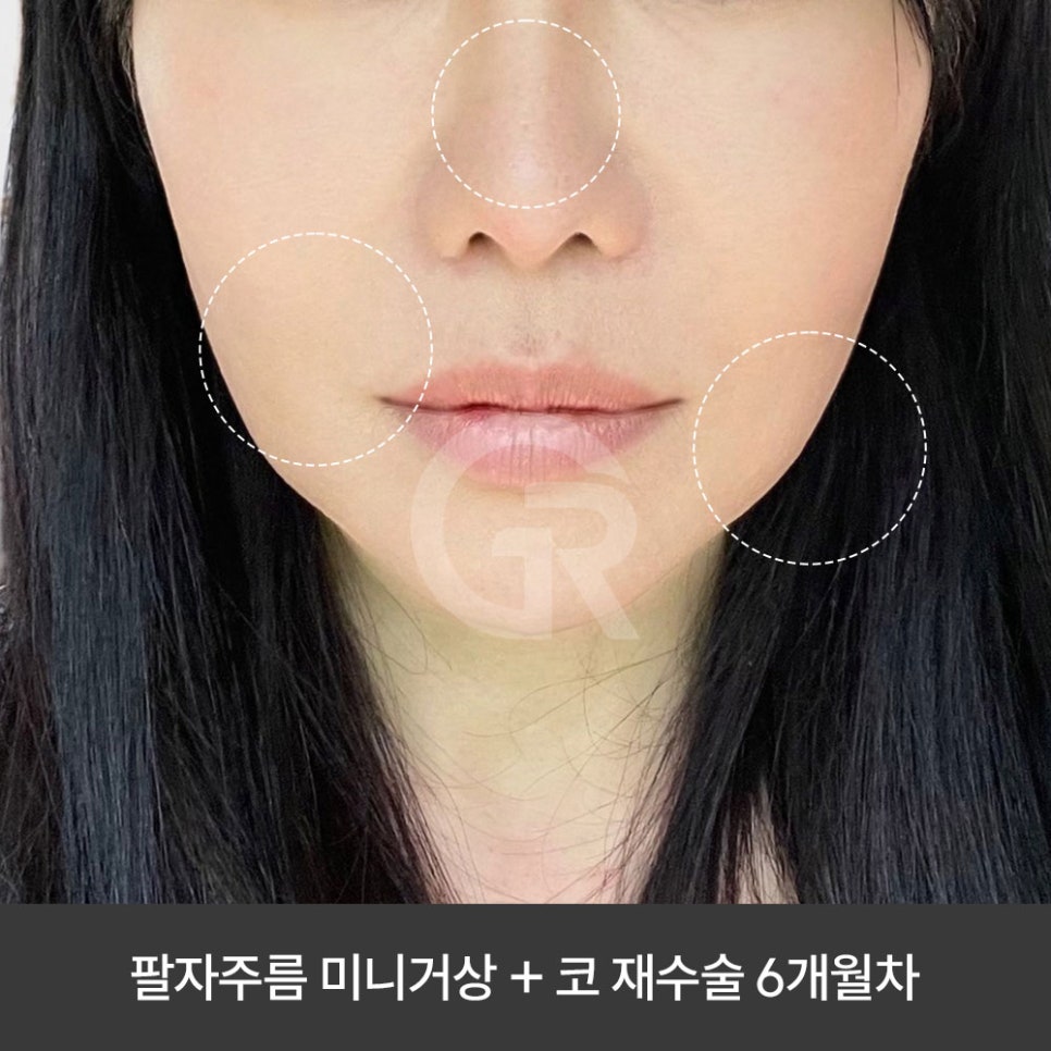 깊은 팔자주름 때문에 미니거상을 진행한 케이스(+코재수술) 관련 이미지 7