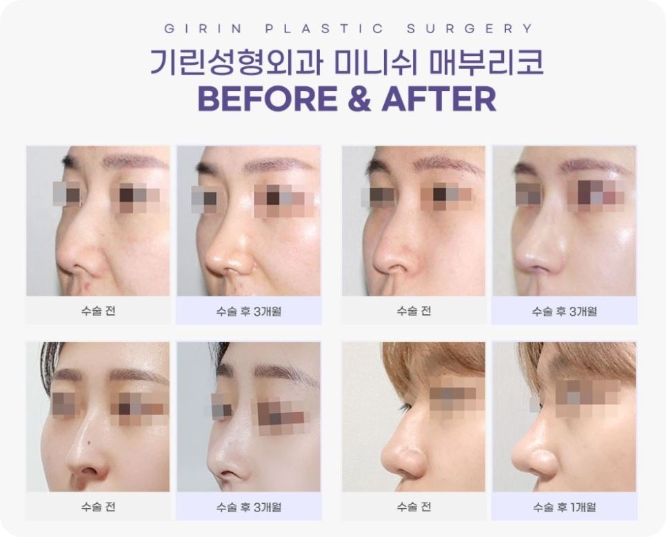 매부리코수술? 콧대만 깎는다고 해결 될까? 관련 이미지 2