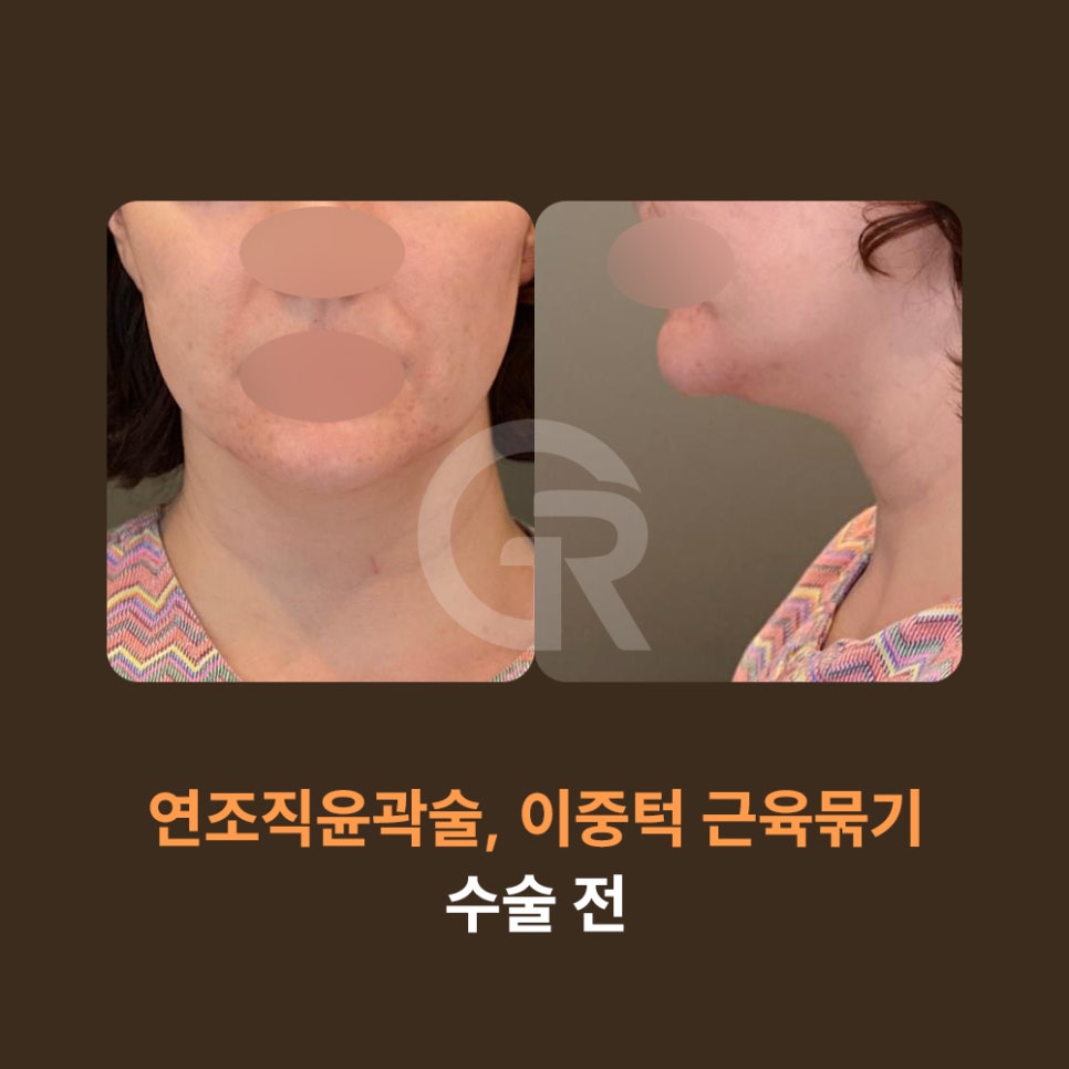 다이어트 후 이중턱은 그대로, 얼굴처짐만 심해졌을 때 해결 방안 관련 이미지 7