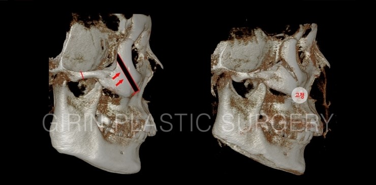 광대뼈수술 시 나사고정위치와 고정갯수가 안전에 영향을 주나요? 관련 이미지 4