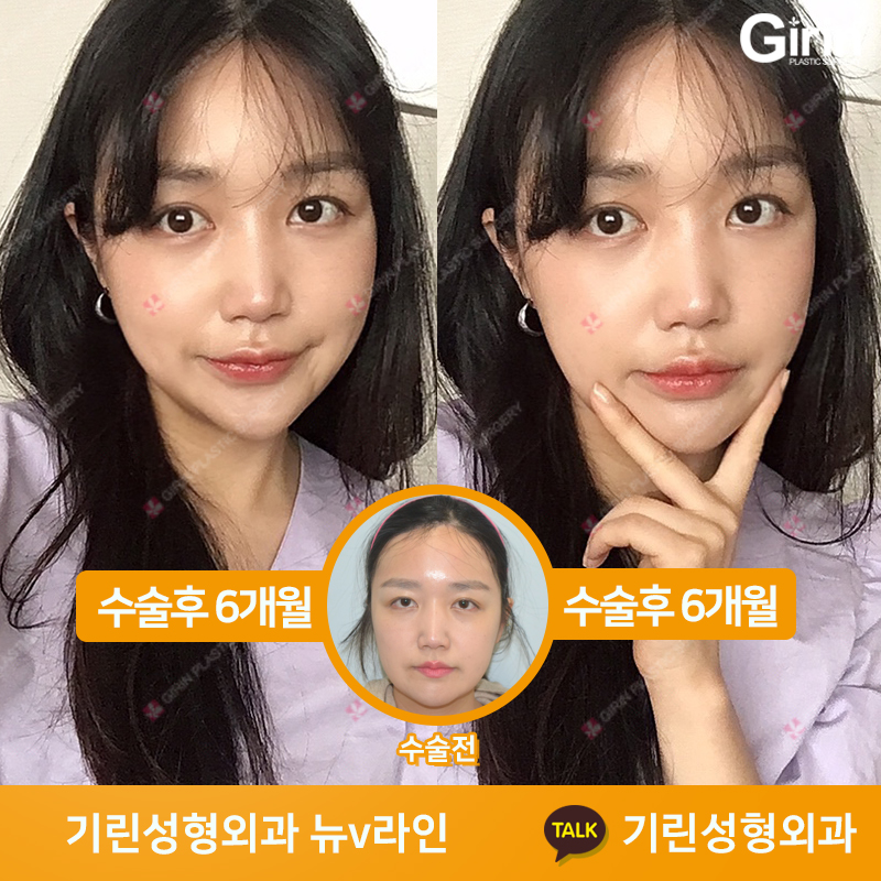 [뉴브이라인] 45도 라운딩 브이라인 절골술로 작은 얼굴 만들기 관련 이미지 7