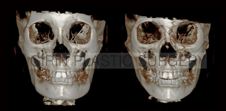 브이라인, 광대고정 사례 관련 이미지 1