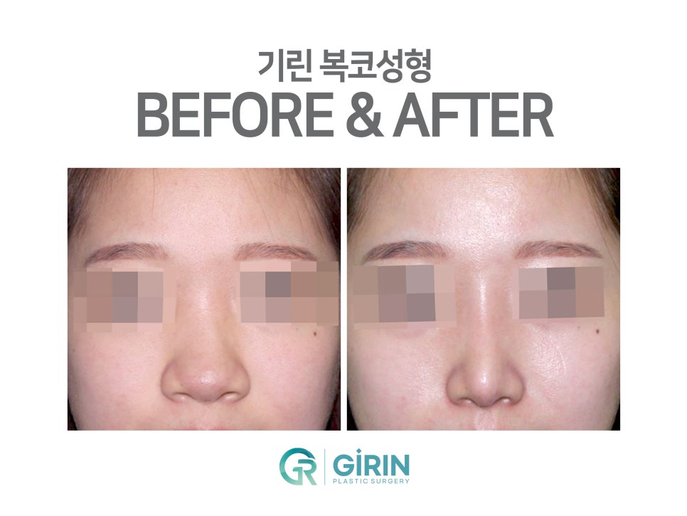 콧볼축소수술후기 주의한 점은 관련 이미지 3