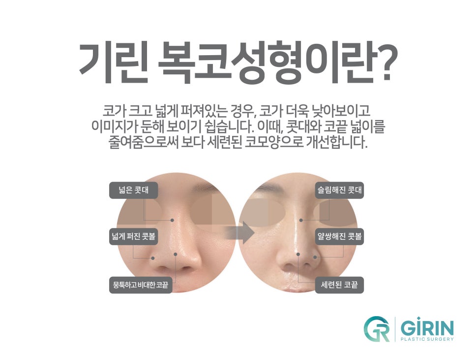 콧볼축소수술후기 주의한 점은 관련 이미지 6