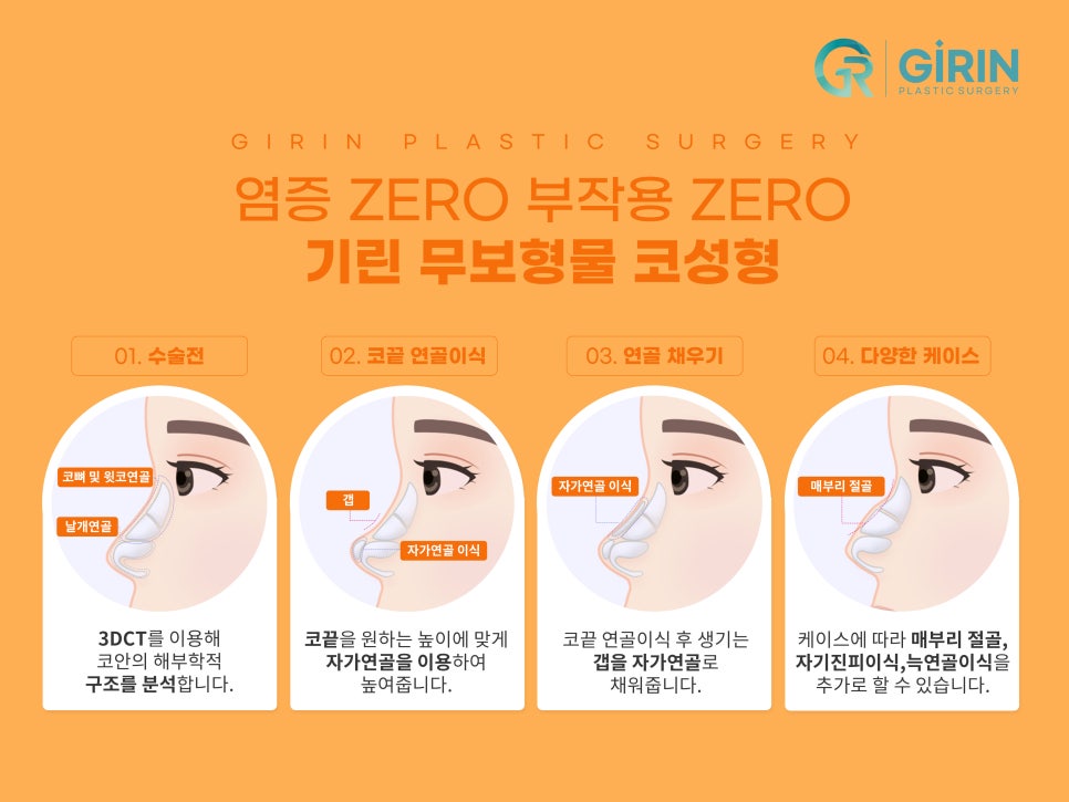 무보형물 코수술 자연스러운 코라인 관련 이미지 4