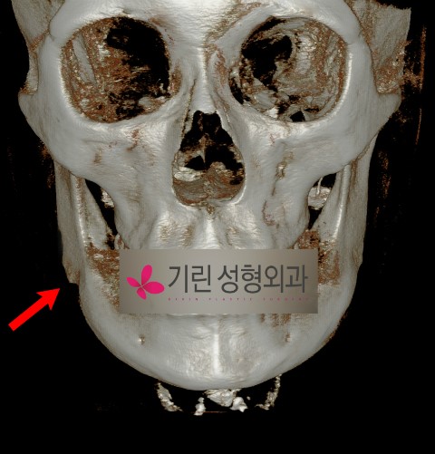 효과미비로 인한 사각턱재수술사례 관련 이미지 3