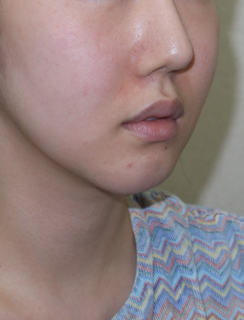 Features of Recently Preferred Facial Shapes, as Seen by a Soft-Tissue Contouring Specialist image 3