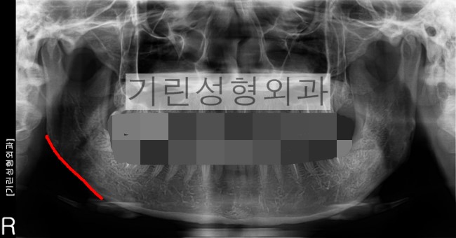 귀뒤사각턱수술 후 부작용: 효과없는 경우 관련 이미지 3