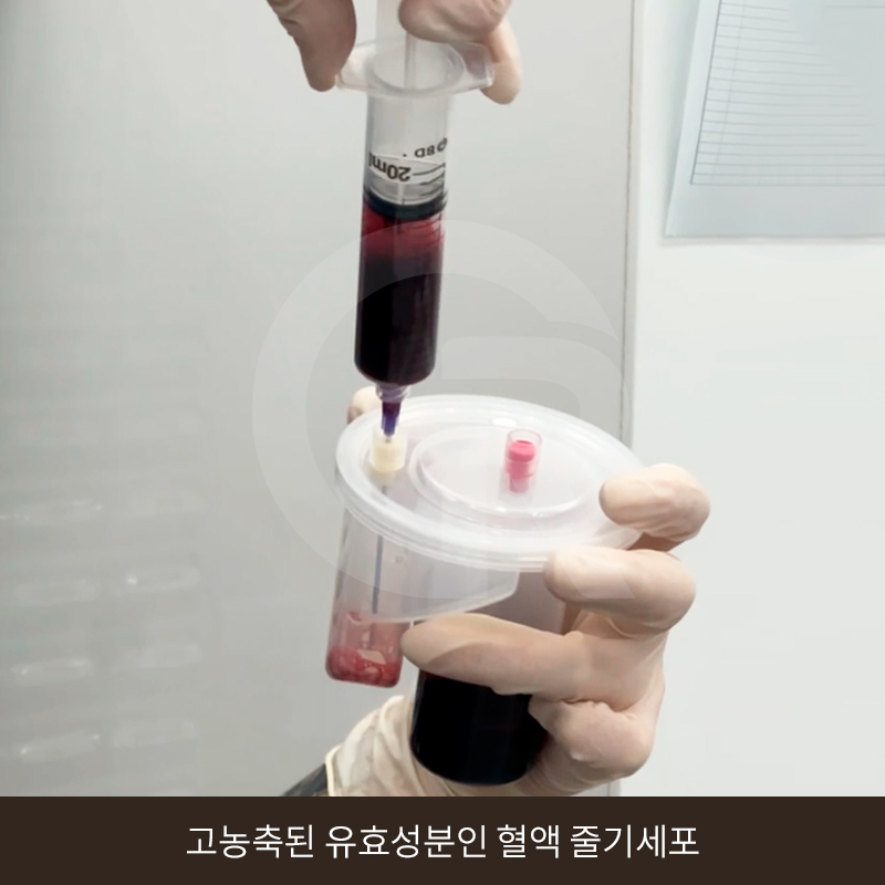 탈모 고민 두피 줄기세포 치료, 가격이 다른 이유는? 관련 이미지 5