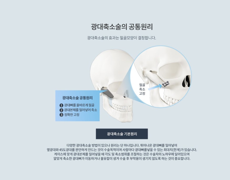 기린 성형외과는 광대축소술을 어떻게 진행하나요? 관련 이미지 1