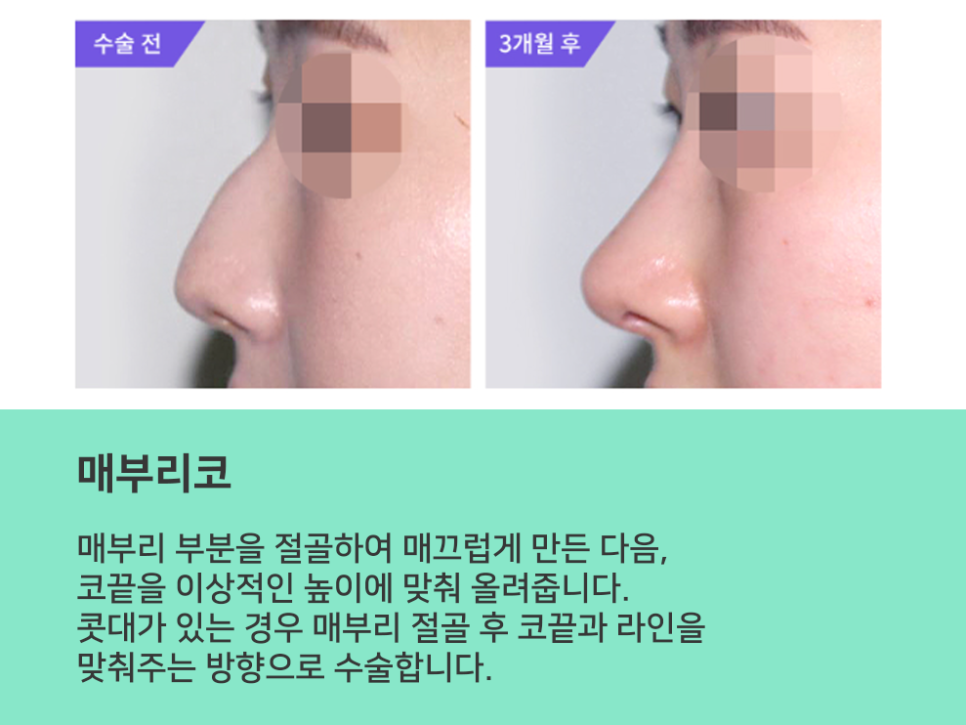 무보형물 코수술 라인을 잡아주며 관련 이미지 8