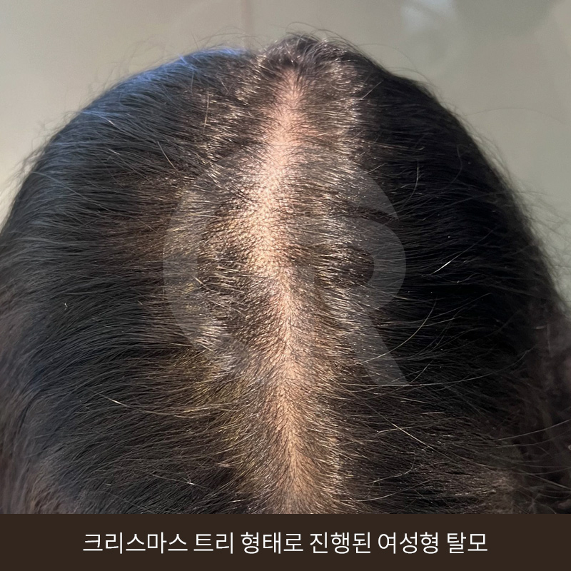 탈모 고민 두피 줄기세포 치료, 가격이 다른 이유는? 관련 이미지 2