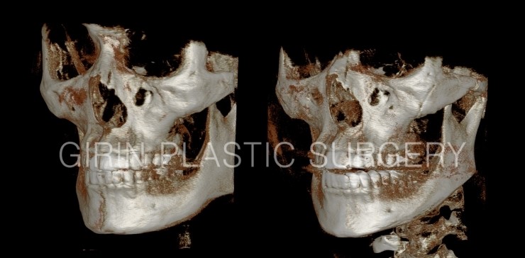 긴곡선(넓은턱), 무고정광대 전후CT 관련 이미지 3