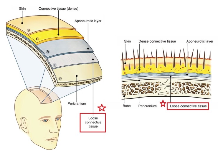[공유] 이마축소술! 어떤 과정으로 수술하는지 알려드립니다 (안심하세요!) <<수술과정 大해부>> 관련 이미지 7