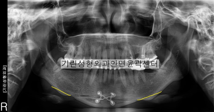 윤곽부작용사례-이차각 관련 이미지 2