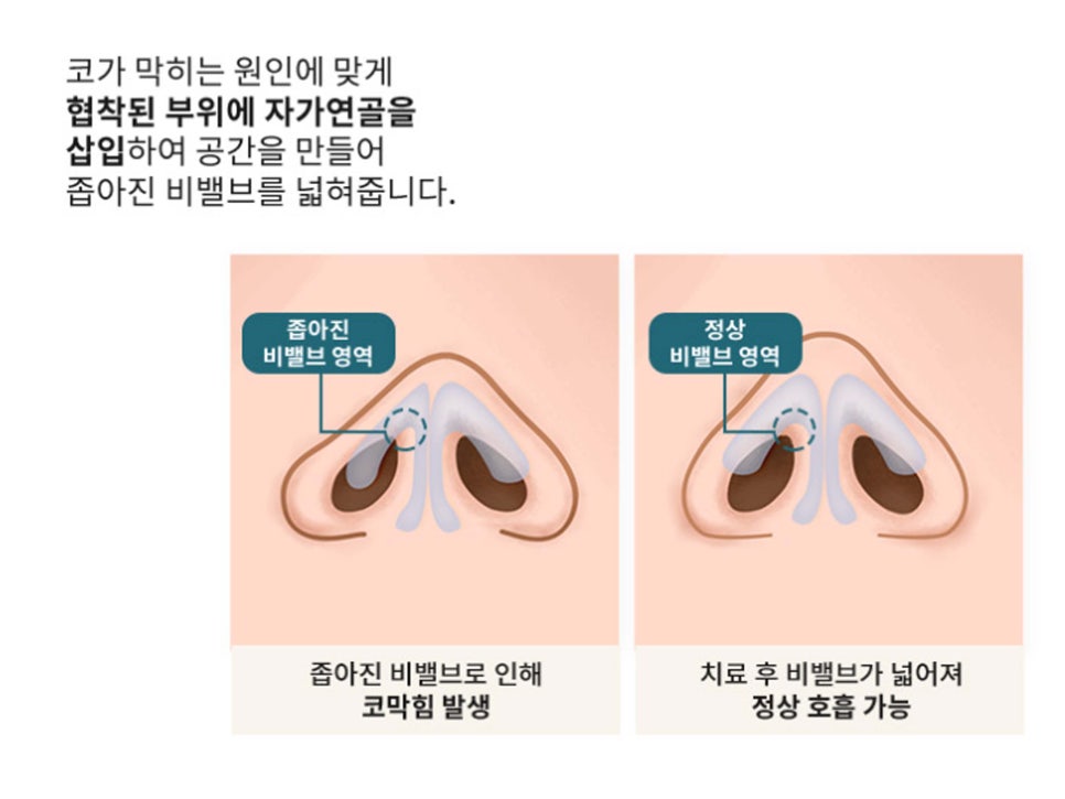 강남기능코성형 원인과 필요성 생각하여 관련 이미지 10