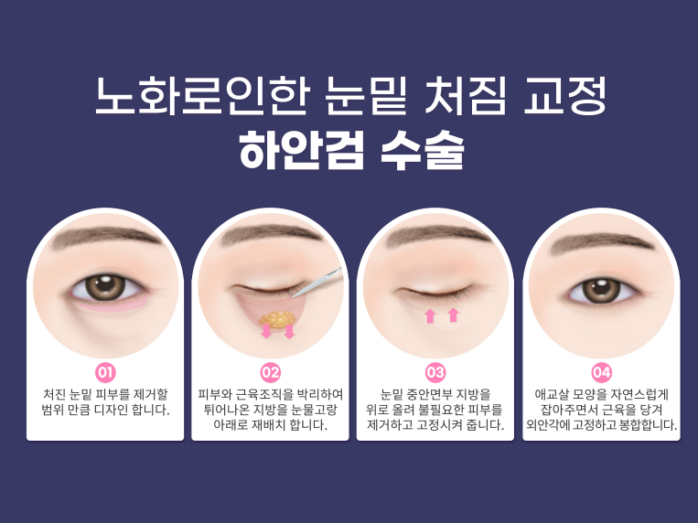 상하안검수술 인상을 바꾸기 위해 관련 이미지 13