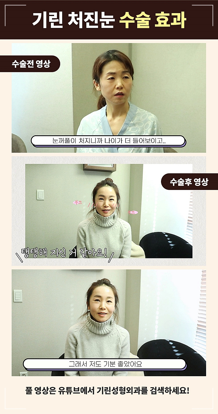 중년눈성형 처진 눈매교정 젊음의 시작 관련 이미지 1