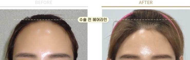[공유] 이마축소술! 어떤 과정으로 수술하는지 알려드립니다 (안심하세요!) <<수술과정 大해부>> 관련 이미지 1