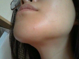 안면윤곽 후 재수술사례 : 부작용으로 인한 재수술 관련 이미지 2