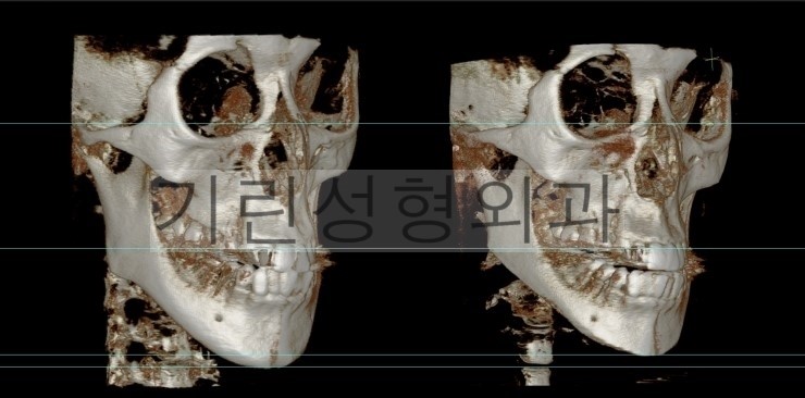 뉴브이라인 긴턱축소 사례 관련 이미지 4