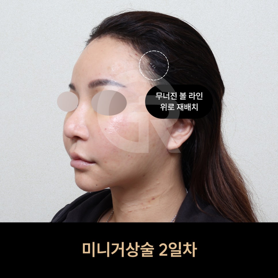 위고비&middot;마운자로 후 얼굴처짐으로 인한 미니거상 후기 관련 이미지 5