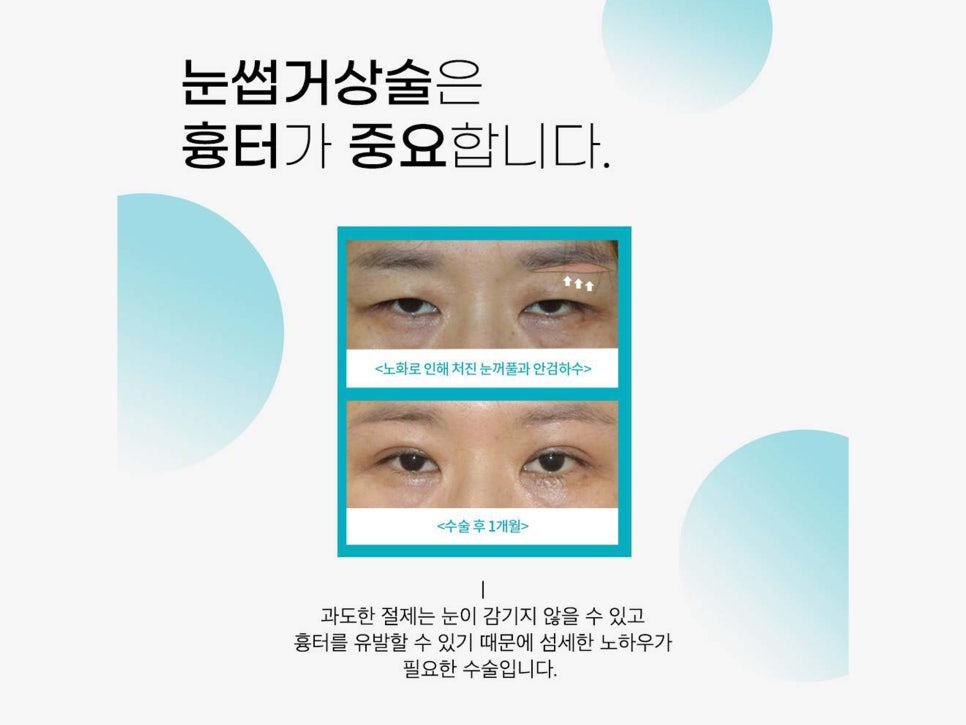 눈썹거상술후기 확인하고 싶다면 관련 이미지 11