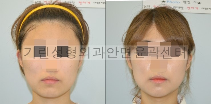 넓은턱수술+아큐스컬프+귀족 1달차 관련 이미지 1