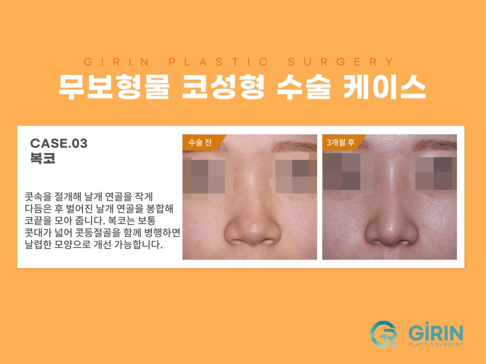 무보형물 코수술 자연스러운 코라인 관련 이미지 7