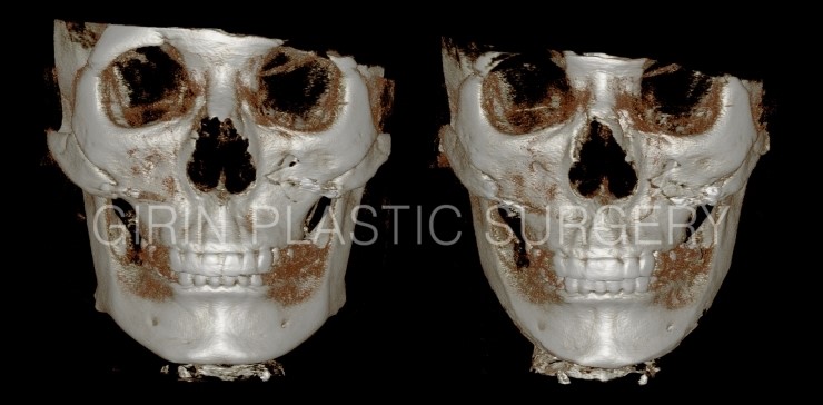 광대재수술+브이라인 전후 관련 이미지 1