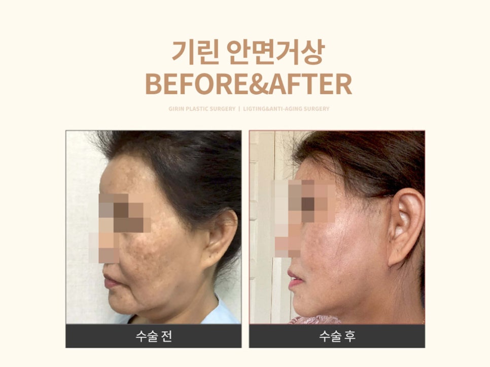 안면거상수술 효과 확실하려면 관련 이미지 1