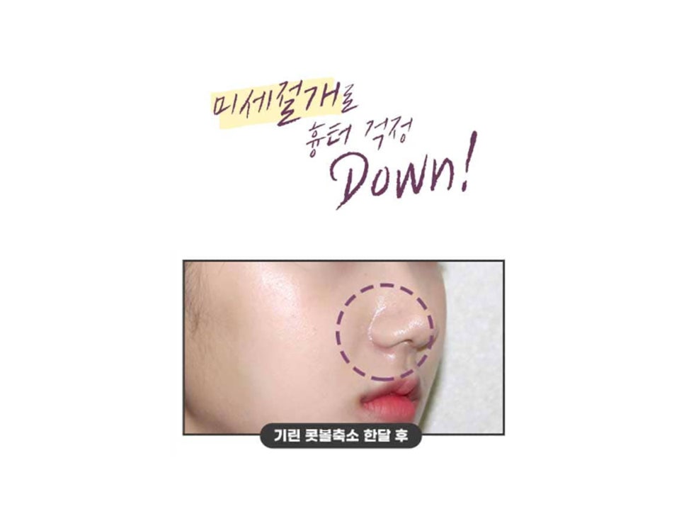 콧볼축소수술전후 얼마나 달라질까 관련 이미지 12