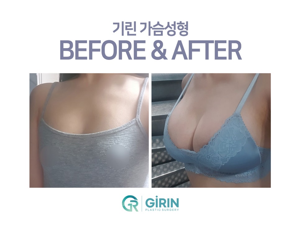 강남가슴성형 달라질 라인 기대하며 관련 이미지 17