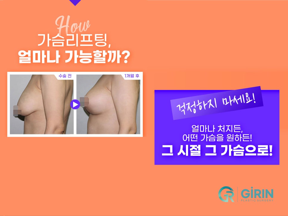 가슴처짐수술 교정으로 자신감 찾아 관련 이미지 3