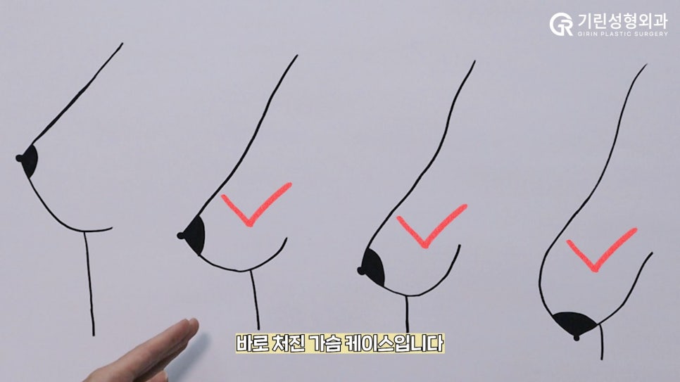 [기린성형외과]가슴거상_처진가슴 자가 진단법 및 수술법 관련 이미지 3