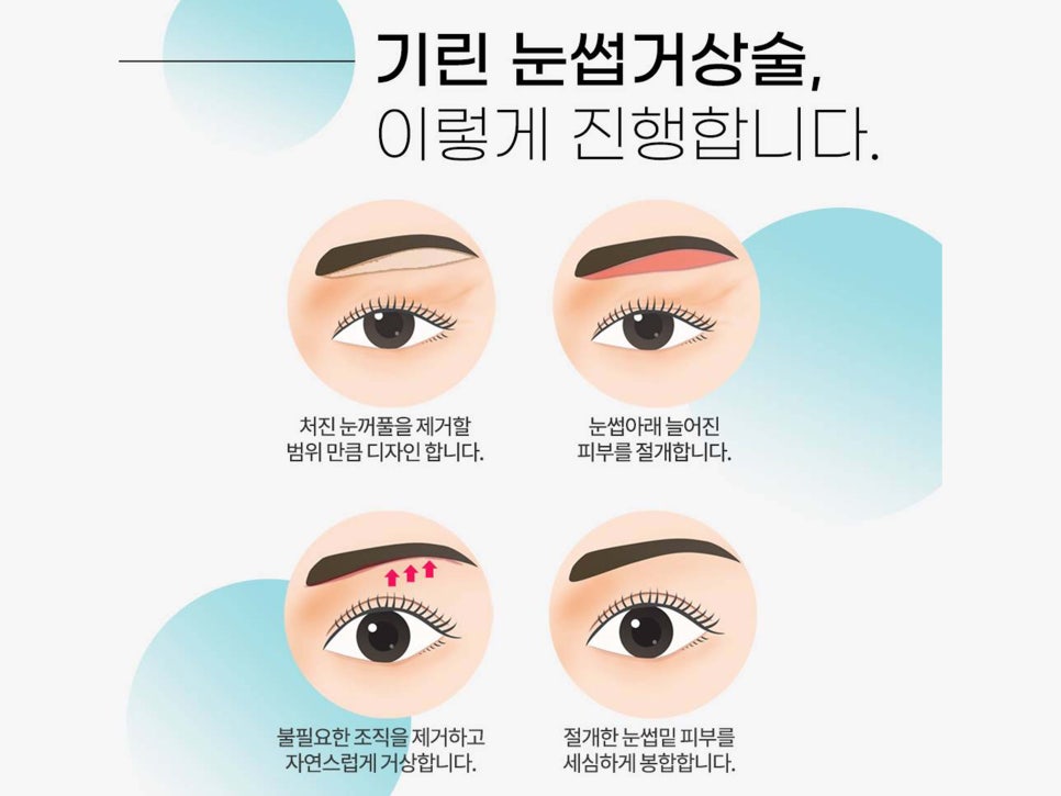 눈썹거상술후기 확인하고 싶다면 관련 이미지 7