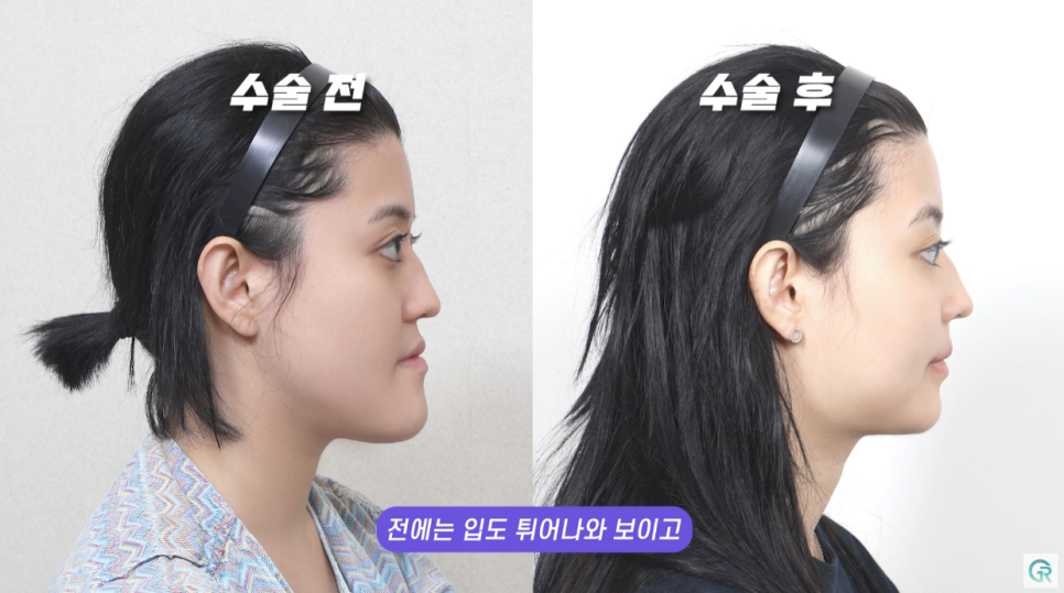 [기린성형외과의원] 눈, 코성형 전 필수 시청_얼굴형이 갖는 미적가치 관련 이미지 7