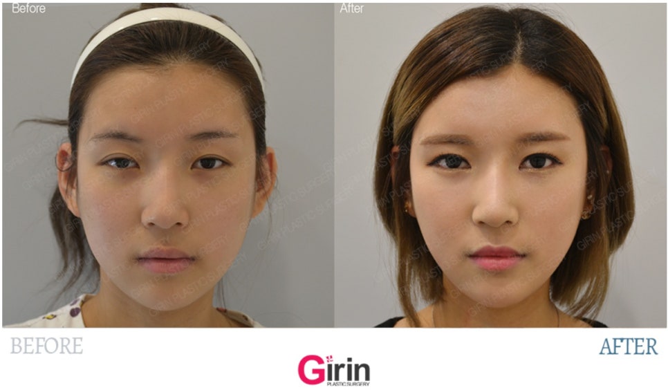 요즘 누가 티나게 성형하니? 기린성형외과 자연유착으로 미모완성♥(+후기) 관련 이미지 10