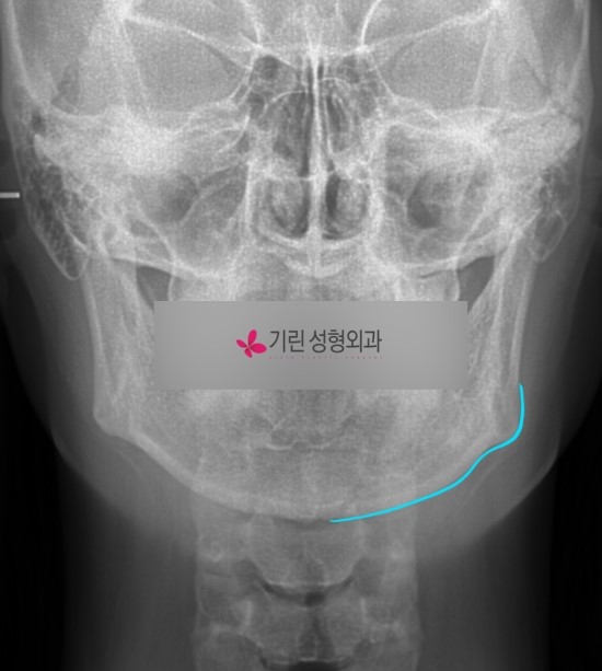 퀵안면윤곽 : 빨리 하는 수술? 붓기가 빨리 빠지는 수술? 관련 이미지 1