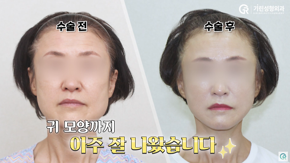 [기린성형외과의원] 부모님들 사이에서 유행하는 성형_안면거상 수술일지 관련 이미지 9