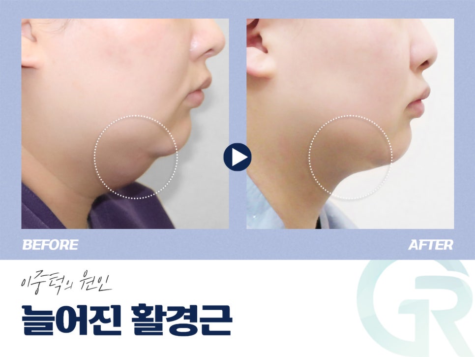 이중턱지흡 생각한다면 관련 이미지 2