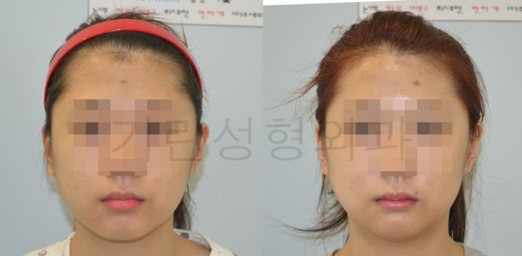 퇴원시 촬영한 긴곡선사각턱 CT영상/ 8일차 경과사진 관련 이미지 1