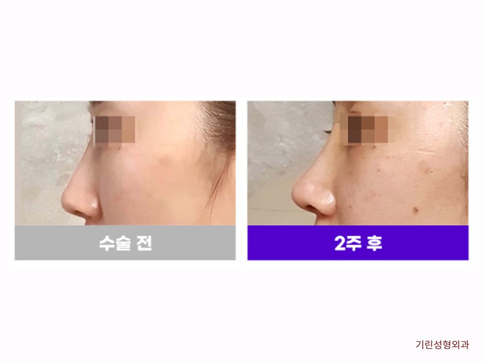 강남코재수술 신중하게 고르자 관련 이미지 11