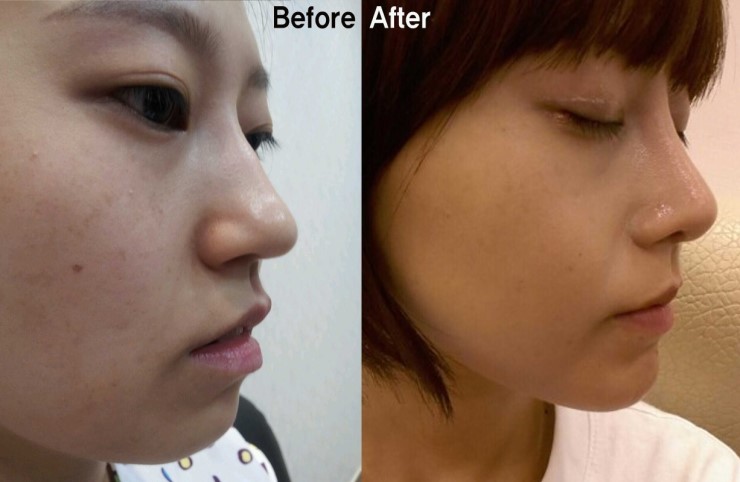 절골을 통한 매부리코 교정수술 (B&A) 관련 이미지 1