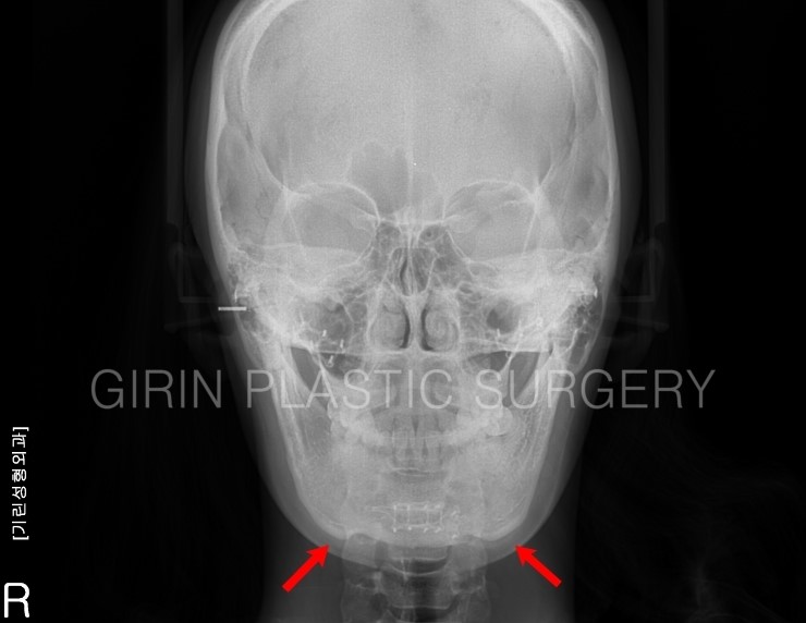 티절골 후 이차각으로 재수술이 필요한 사례 관련 이미지 1