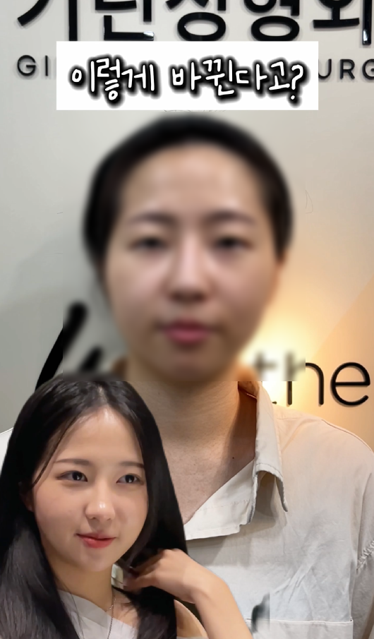 강남역 근처 쌍꺼풀 잘하는 곳 어디? 생생한 후기 관련 이미지 1