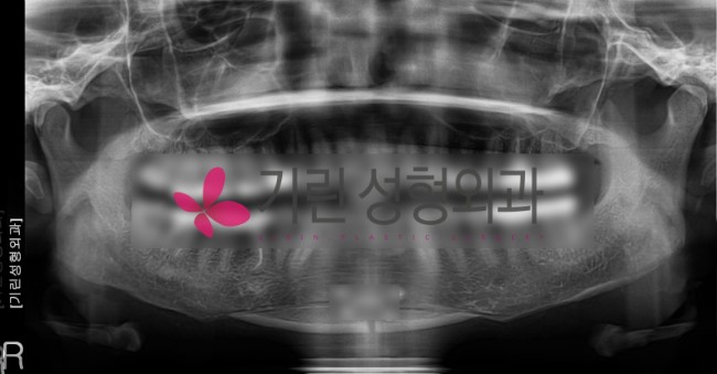 사각턱재수술 - 이차각의 제거 관련 이미지 1