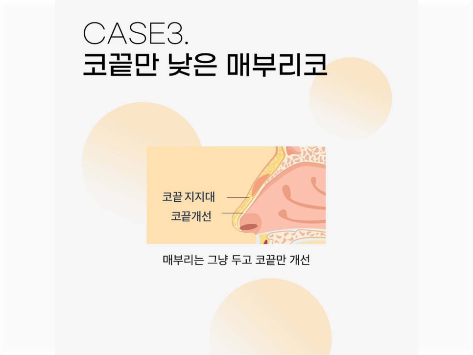 매부리코수술후기 올바른 라인으로 관련 이미지 11